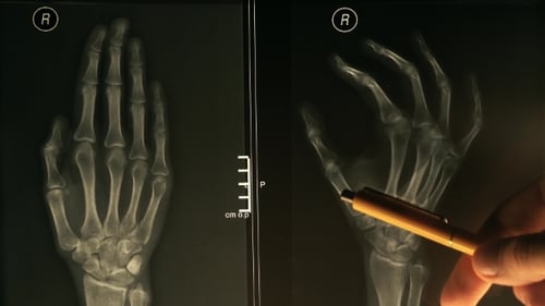Hand X-Ray Examined by Doctor with a Pen