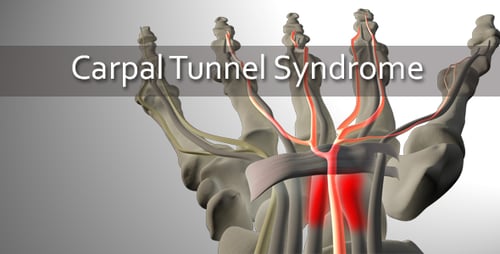 Carpal Tunnel Syndrome