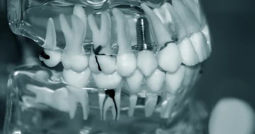 Dental Model Shows Implant and Teeth