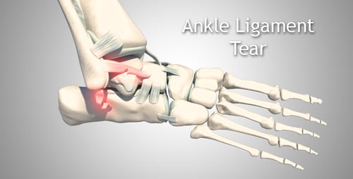 3D Human Foot and Ankle Bones with Ligaments and Inflammation