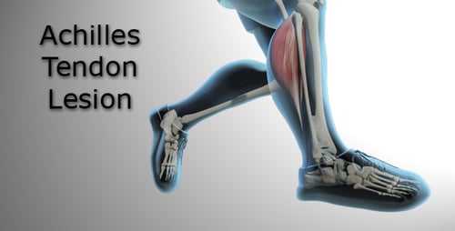 3D Running Human Skeleton with Leg Anatomy and Fibula Fracture