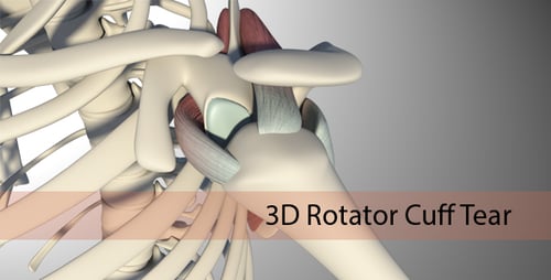Human Shoulder Joint Anatomy and Inflammation Animation