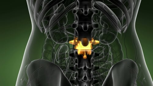 3D Medical Visualization of Lumbar Spine Pain
