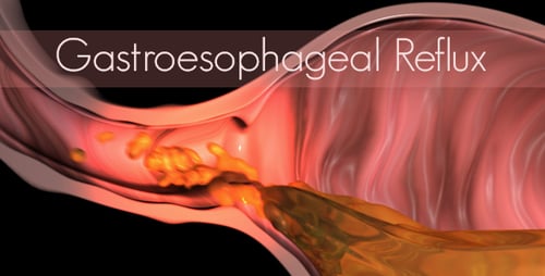 3D Animation of Stomach Acid Reflux and Esophageal Irritation
