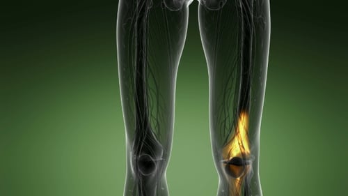 Digital Scan of Human Legs with Glowing Knee Pain