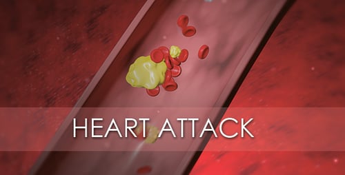 Heart Attack