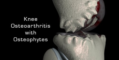 Knie-Arthrose mit Osteophyten