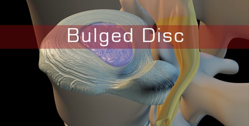 Herniated Disc Nerve Compression Medical Animation