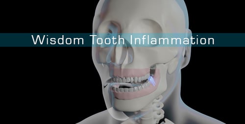 3D Animated Medical Illustration of an Impacted Wisdom Tooth