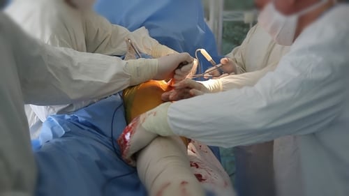 Orthopedic Surgeons Inserted a Big Metallic Stick in a Human Coxal Joint in a Room