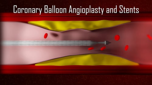 Angioplastia con balón coronario y stents