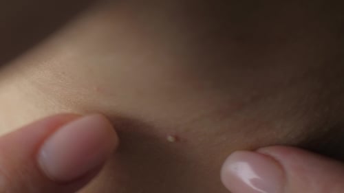 Squeezing Pimple
