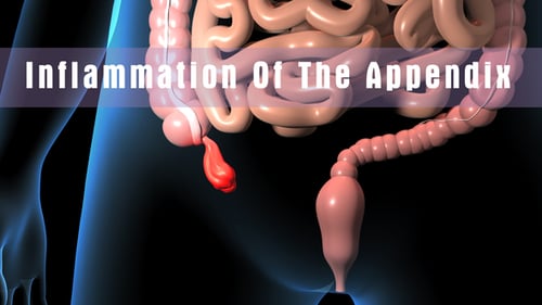 Animated Human Digestive System Showing Inflamed Appendix