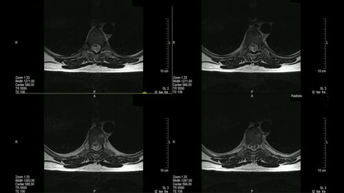 Real MRI Scan of Doctor Examining the Thoracic Spine
