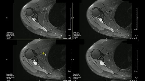 Medical Scan Showing Shoulder in Hospital