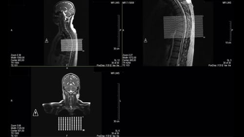 Real MRI Scan of Doctor Examining Brain and Thoracic Spine