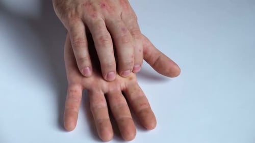 Close Up of Hands with Bumpy Red Rash