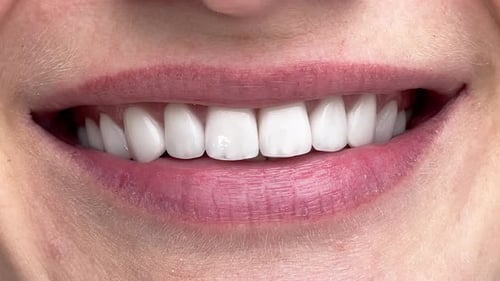 Perfect White Teeth Close Up Female Veneer Smile Dental Care and Stomatology Dentistry