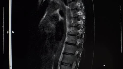 MRI Scan Displays the Structure of Human Spine