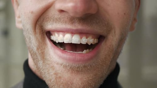 Handsome happy man smile with dental braces close up.