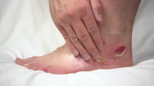 Ein Mann schmiert eine Salbe auf ein Bein mit einem Heißwasserbrand zweiten Grades. Die Haut war in Klumpen geschwollen