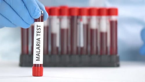 Malaria Blood Test in Medical Lab Setting