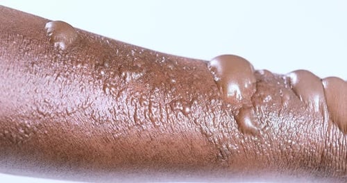 Extreme Close Up of Blistered Arm