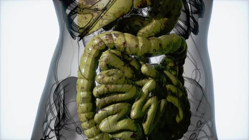 Diseased Human Digestive System Medical 3D Animation