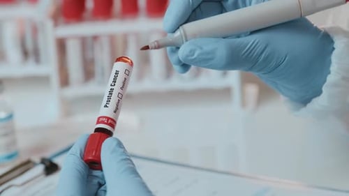 The Doctor Holds Hand Laboratory Positive Blood Test Tube for Cancer Prostate