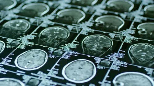 MRI Scan on Brain