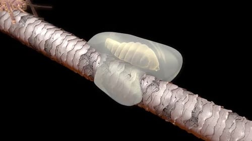 Lice on Hair Close Up