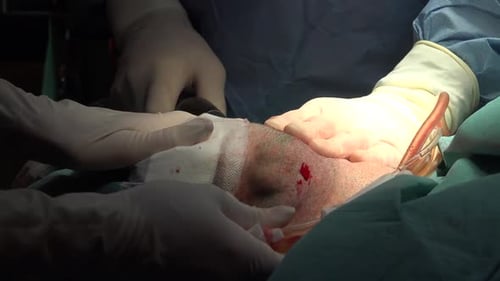 Face and Neck Liposuction for Man