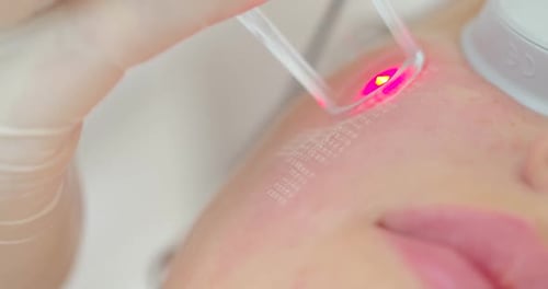 Laser Skin Treatment Performed by Cosmetologist