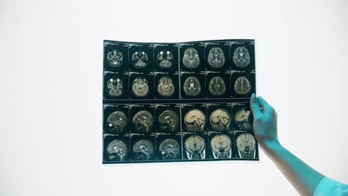 MRI Brain Scan Held By Arm