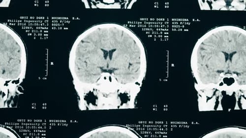 Brain Scan X-ray in Hospital Close Up