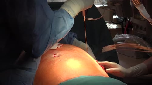 Liposuction And Belly Fat 10