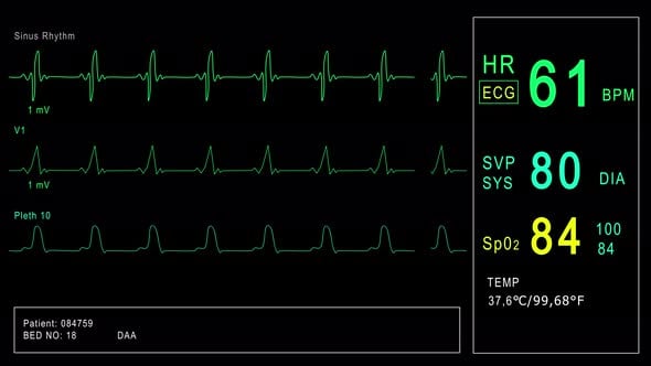 Looped: Patient Monitor Displays Vital Signs ECG Electrocardiogram EKG ...