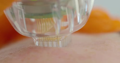 Close-up. Microneedle RF Lifting Procedure. Hardware Cosmetology. Beautician Conducts a Facial