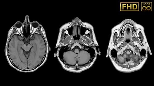 Mri Brain Skull Overhead
