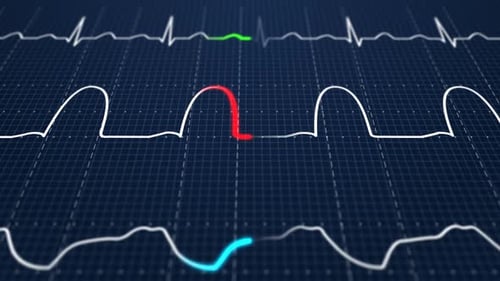 Animation of Intensive Care Unit monitor showing normal values for vital signs.
