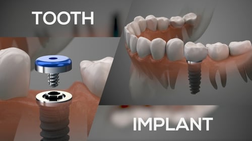 3D Dental Implant Installation Procedure Animation