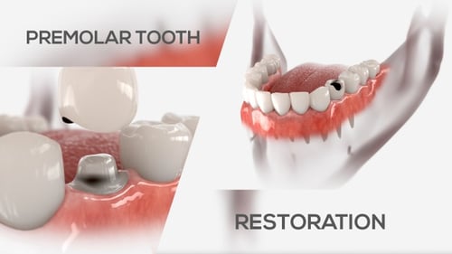 Dental Tooth Cavity Filling and Crown Application 3D Animation