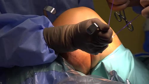 Surgeon Performing Orthopedic Surgery with Sutures