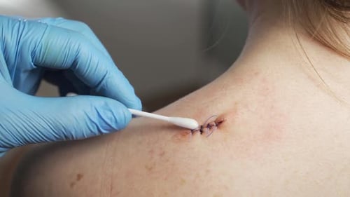 Sutured Wound Being Cleaned with a Q Tip