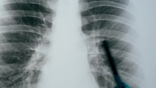 Examining Lung X-Ray with Teal Gloves