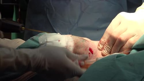 Face and Neck Liposuction for Man 2