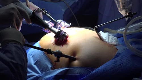 Bariatric Surgery or Gastric Bypass Surgery 2