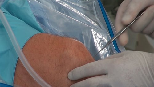 Surgeons Perform Arthroscopic Knee Surgery in Hospital