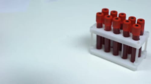 Adenovirus Positive Blood Sample in Test Tube