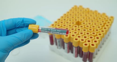 COVID-19 Positive Blood Test in Lab